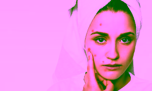 Acne problem sample image - urja ayurveda
