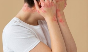 Psoriasis skin treatments - urja ayurveda panchakarma