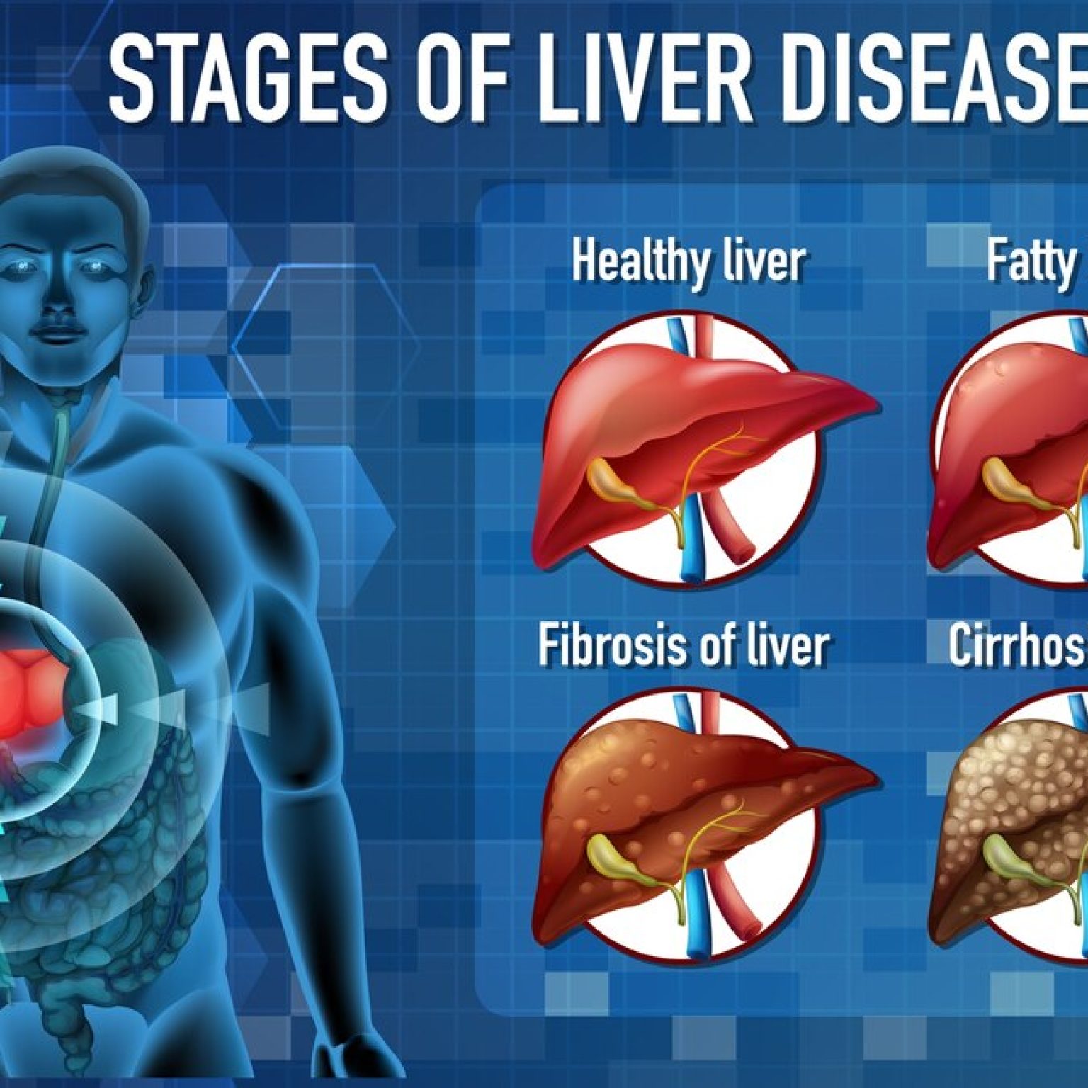 stages of liver disorder